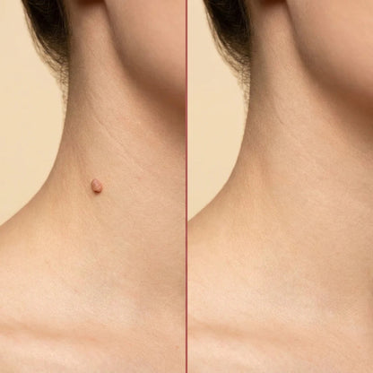 BelBexa™  ClearTag Microneedle skin tag patch