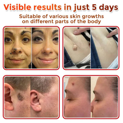 BelBexa™  ClearTag Microneedle skin tag patch